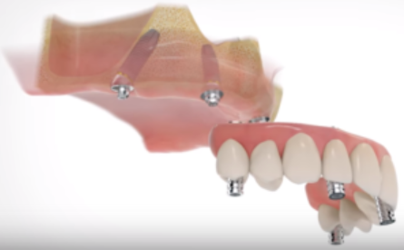 All On Four Dental Implants Long Island